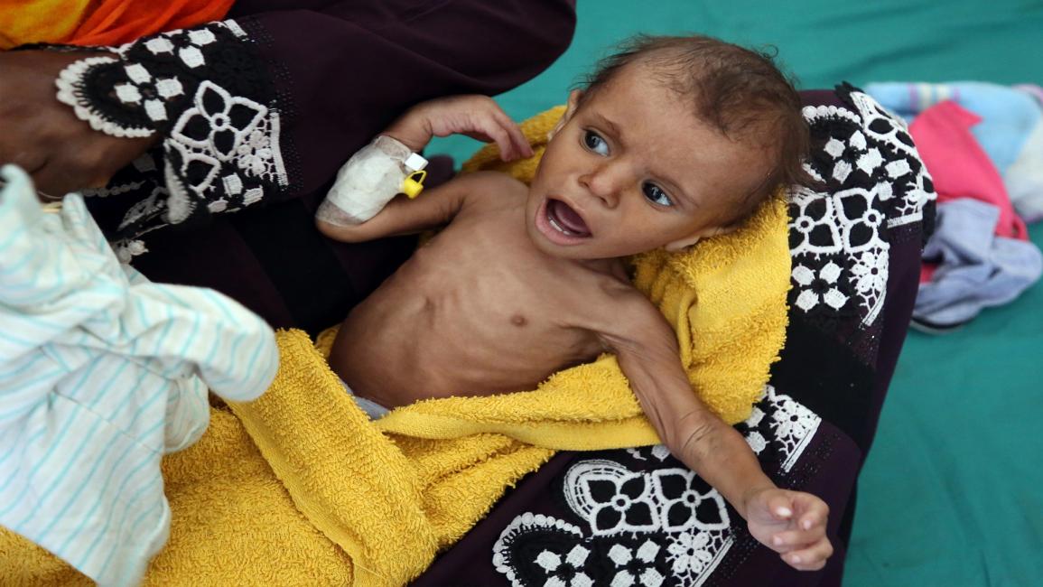 سوء التغذية الشديد في اليمن (أحمد الباشا/فرانس برس)