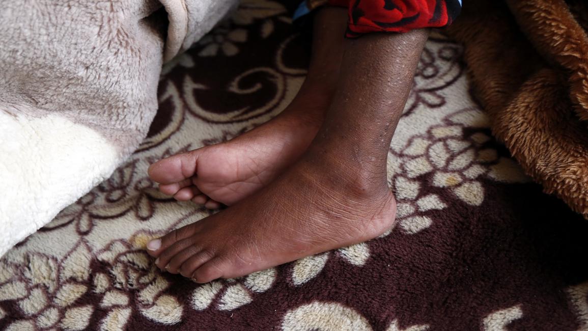 مجاعة في اليمن/مجتمع (محمد حمود/ Getty)