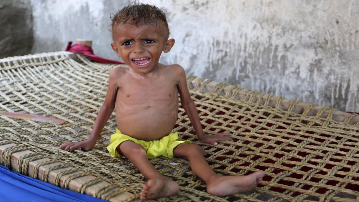 طفل يمني يعاني سوء تغذية - اليمن - مجتمع