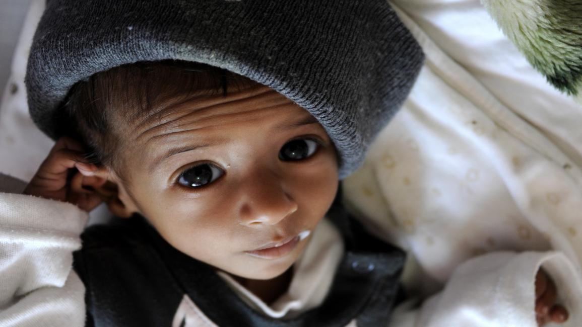 طفل يمني وسوء تغذية في اليمن - مجتمع 