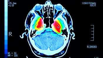 صورة دماغ تشير إلى إصابة بمرض باركنسون (بيتر دييزلي/ Getty)