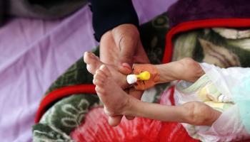 أطفال يمنيون وسوء تغذية في اليمن (محمد حمود/ Getty)