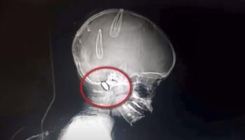 صورة إشعاعية لرصاصة في قاعدة جمجمة الطفلة نايا حنا في لبنان (إكس)