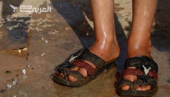 أمراض جلدية تغزو مخيمات النازحين شمال سورية
