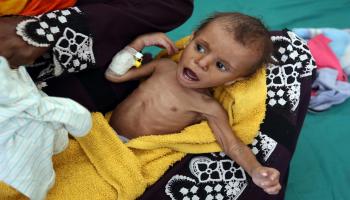 سوء التغذية الشديد في اليمن (أحمد الباشا/فرانس برس)