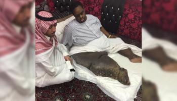 وزارة الصحة السعودية تعالج مريض (داء الفيل) في الخارج